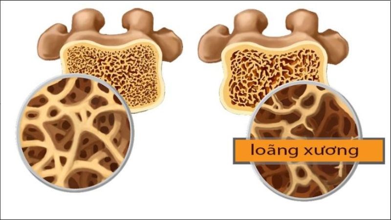 Bổ sung collagen làm tăng mật độ khoáng xương và giảm thiểu nguy cơ loãng xương