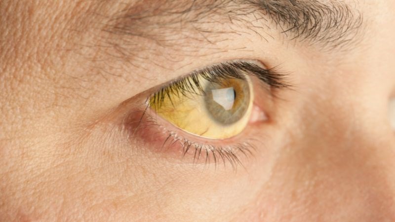Thừa vitamin K có thể gây vàng da