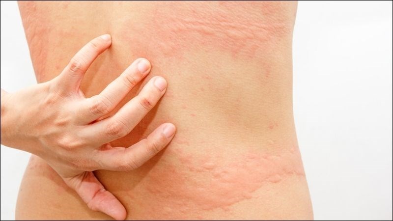 Dùng quá nhiều bạc hà có thể gặp phản ứng dị ứng