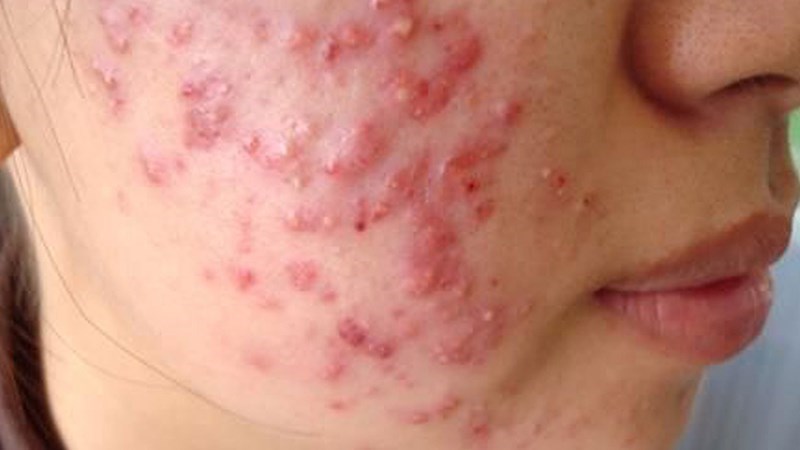 Vitamin C trong atiso giúp làm giảm mẩn đỏ và viêm nhiễm của mụn