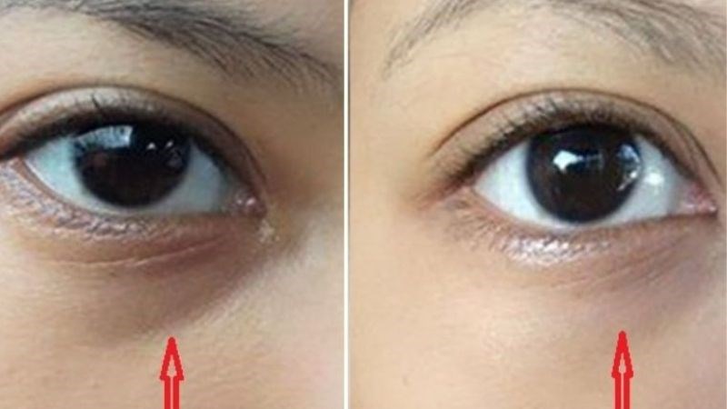 Bạc hà có thể làm giảm bớt quầng thâm mắt nhờ chứa chất chống oxy hóa