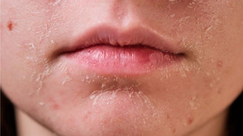 Da bị khô và bong tróc là tác dụng phụ thường gặp khi dùng retinol Da bị khô và bong tróc là tác dụng phụ thường gặp khi dùng retinol