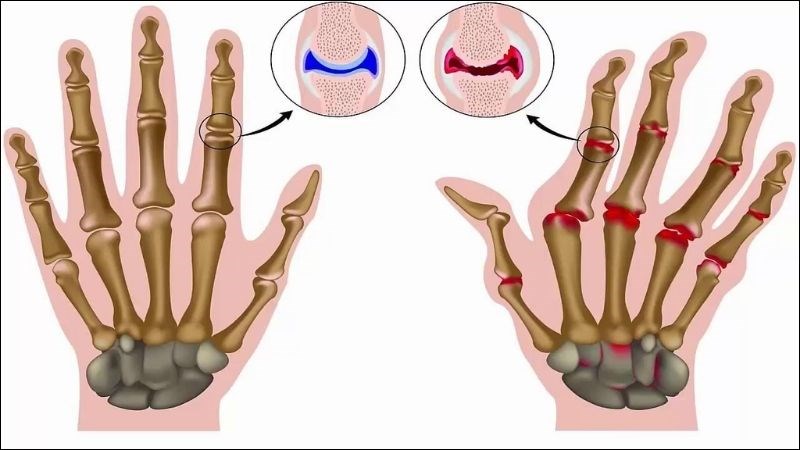 Tinh dầu sả có thể giúp cải thiện các triệu chứng của bệnh viêm khớp dạng thấp 