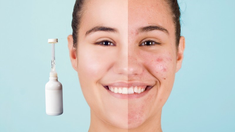 Retinol làm giảm tình trạng bít tắc lỗ chân lông để điều trị mụn trứng cá