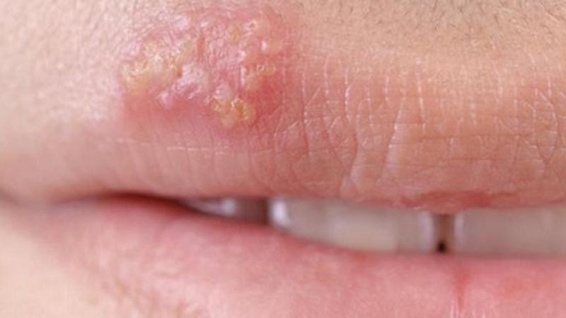 Lysine giúp ngăn chặn sự hình thành và phát triển của virus gây vết loét lạnh