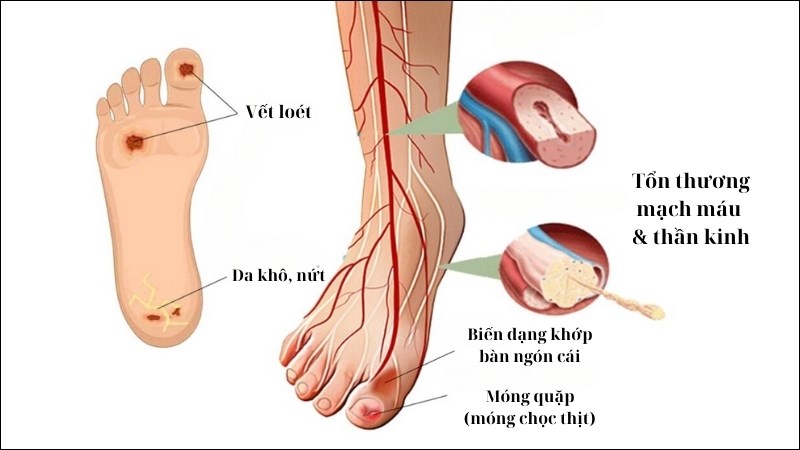 Mật ong Manuka hỗ trợ bảo vệ các vết loét do tiểu đường khỏi tình trạng viêm nhiễm