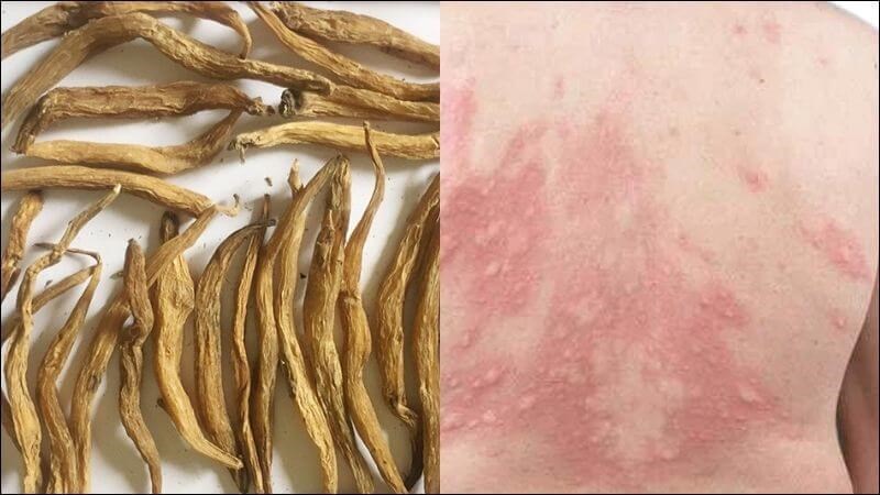 Bài thuốc kết hợp bách bộ, bằng sa, hùng hoàng hỗ trợ điều trị mề đay