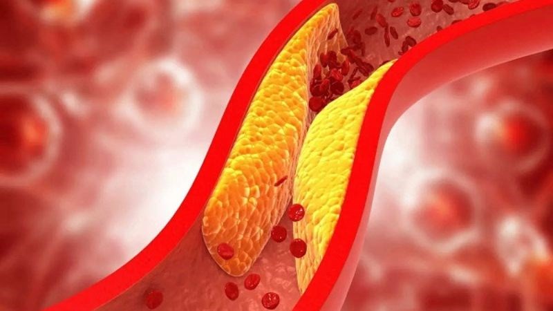 Gừng giúp giảm nguy cơ xơ vữa động mạch
