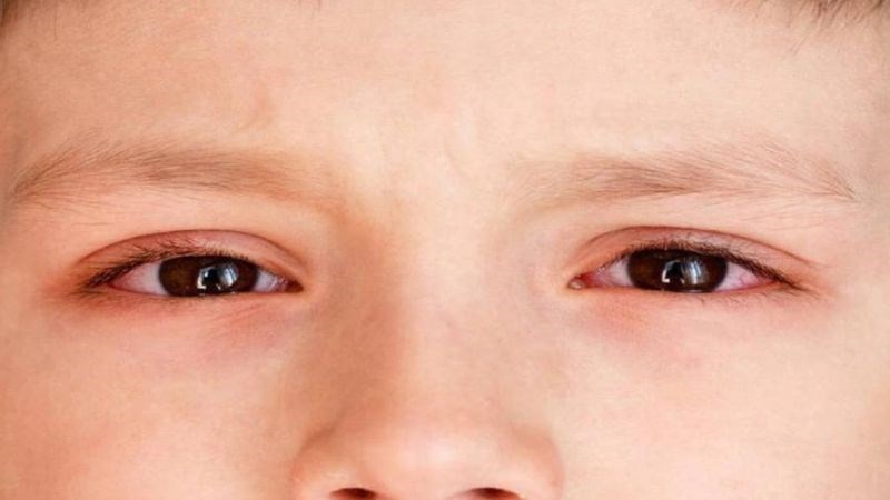 Bendazac lysine giúp kiểm soát bệnh đục thủy tinh thể