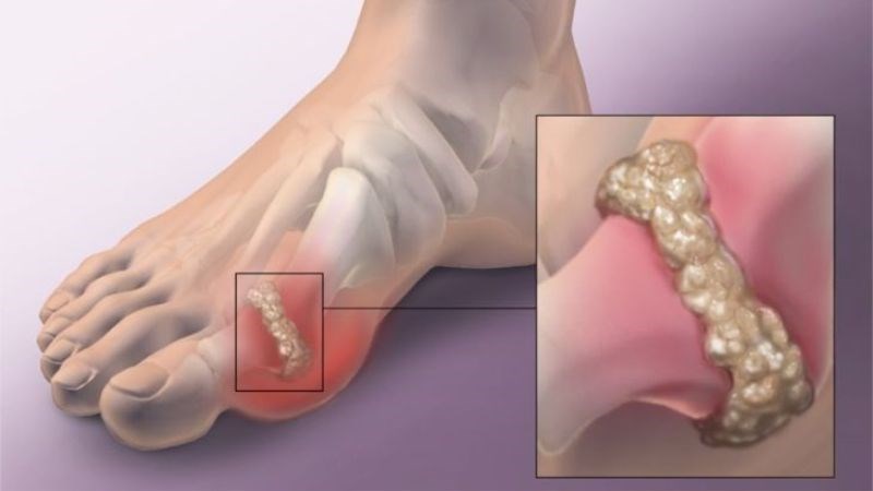 Ăn thực phẩm nhiều đường có thể làm khởi phát đợt gút cấp
