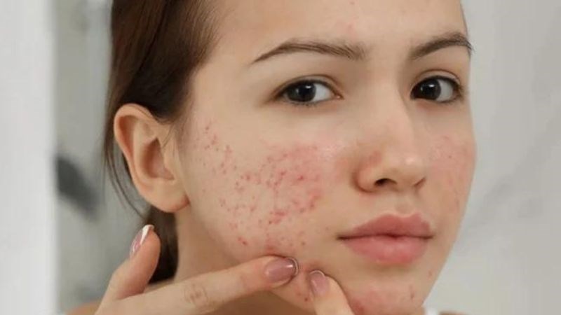 Nổi mụn trứng cá là hiện tượng thường gặp nếu thường xuyên ăn đường