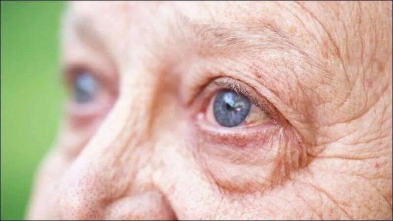 Lutein có thể cải thiện sức khỏe mắt cho những người bị thoái hóa điểm vàng