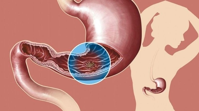 Chiết xuất lá bồ công anh giúp giảm tình trạng viêm loét dạ dày