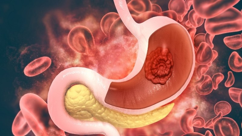 Chiết xuất rễ bồ công anh có tiềm năng ngăn ngừa phát triển ung thư dạ dày