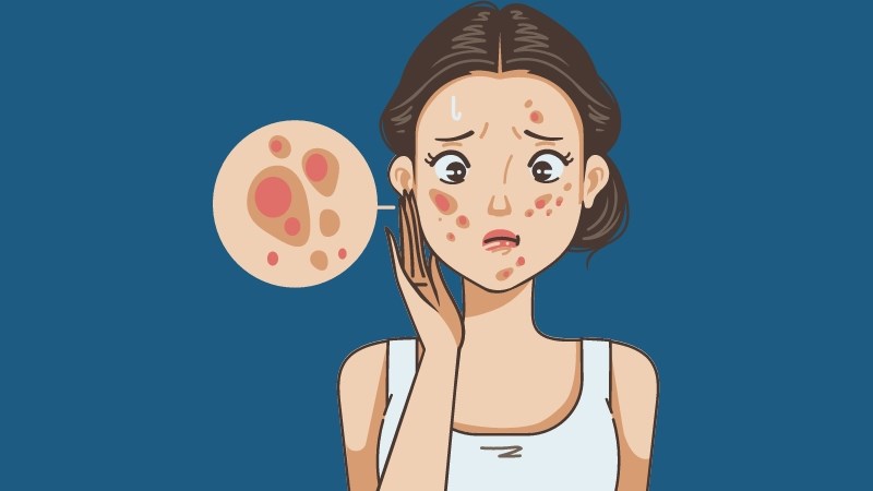 Thí nghiệm in vitro chứng minh rằng Cúc tím có hiệu quả trong giảm viêm và tiêu diệt vi khuẩn gây mụn
