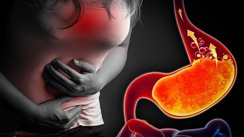 Trào ngược dạ dày là bệnh lý do sự di chuyển ngược của acid dạ dày lên thực quản