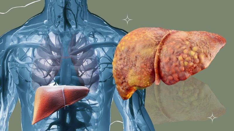  Cây kế sữa giúp kéo dài tuổi thọ ở những bệnh nhân bị xơ gan do rượu