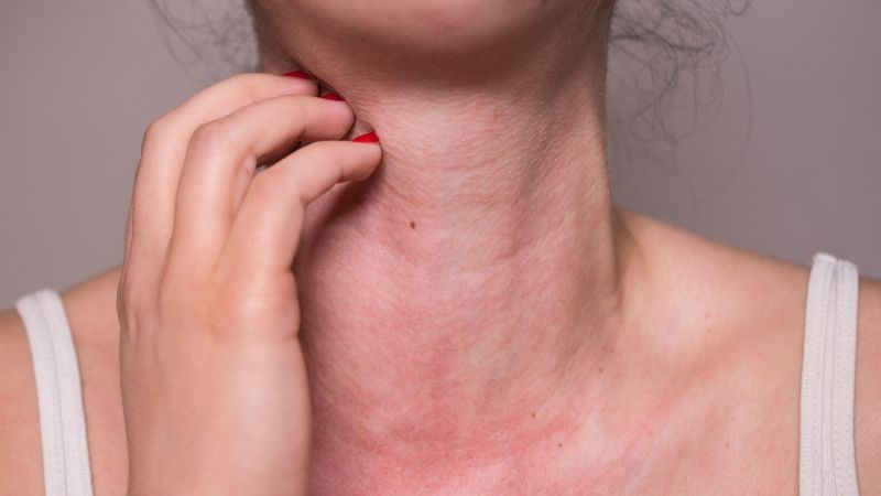 Không nên sử dụng cây kế sữa nếu bạn có tiền sử dị ứng với cỏ phấn hương, cúc vạn thọ, hoa cúc