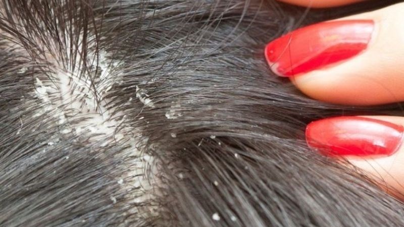 Dầu cà rốt và nước cốt chanh có đặc tính kháng khuẩn, giúp làm dịu da đầu bong tróc