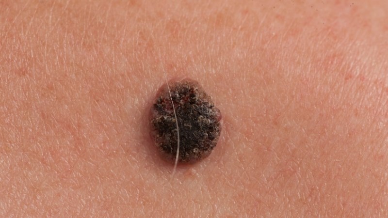 Carotenoid giúp ngăn ngừa ung thư da
