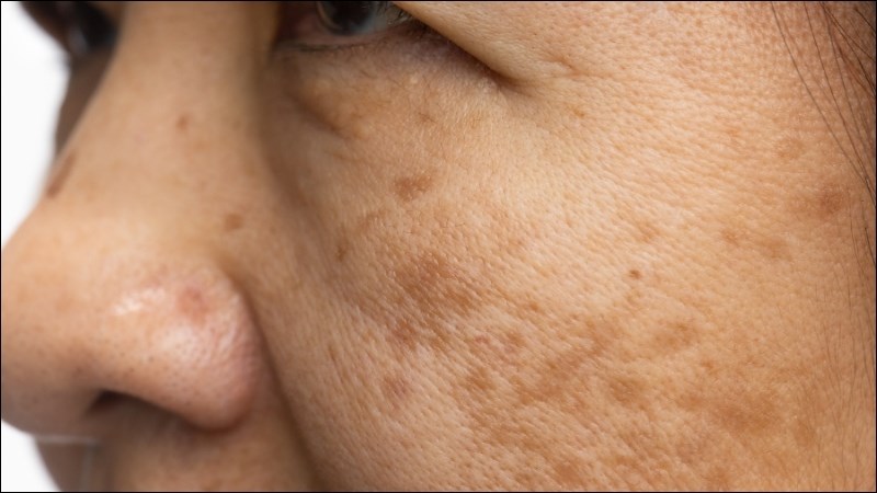 Carotenoid giúp ngăn ngừa lão hóa da