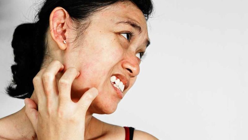 Chanh có thể gây khô da, đỏ, ngứa rát da