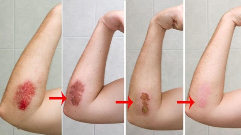 Tinh dầu chanh có thể ngăn ngừa nhiễm trùng và giúp vết thương mau lành hơn
