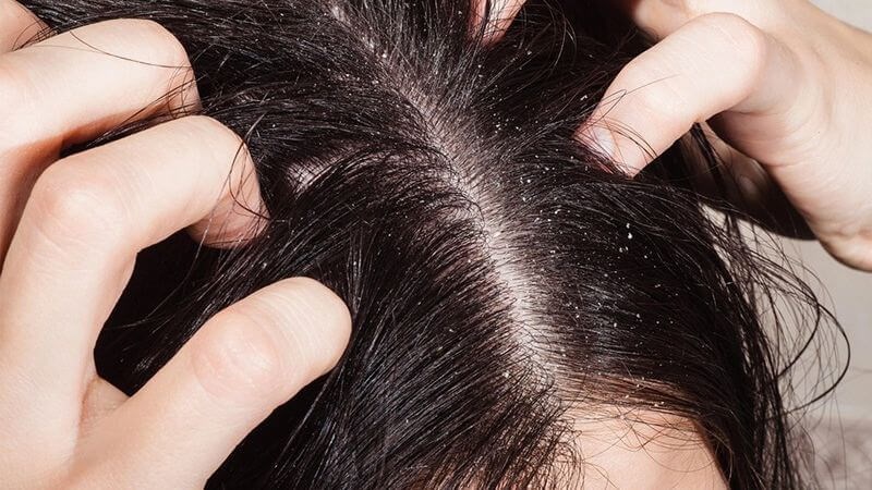 Hạt lanh giúp giảm các vấn đề như gàu, ngứa da đầu, rụng tóc có sẹo và các tình trạng da đầu khác