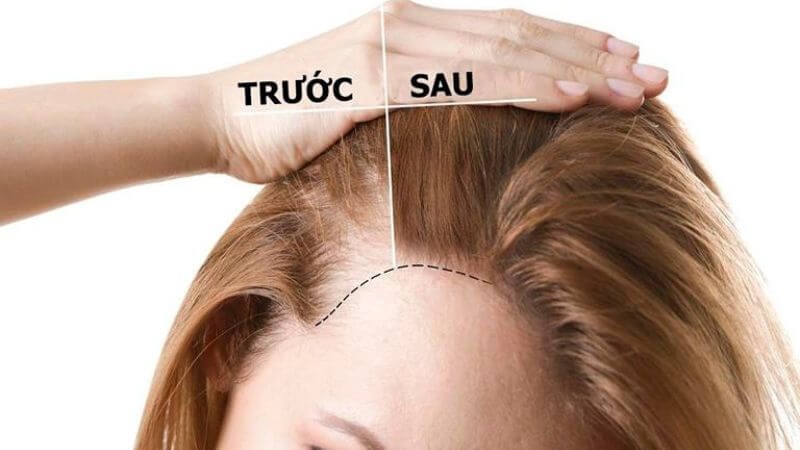 Dầu hạt lanh hỗ trợ quá trình mọc tóc