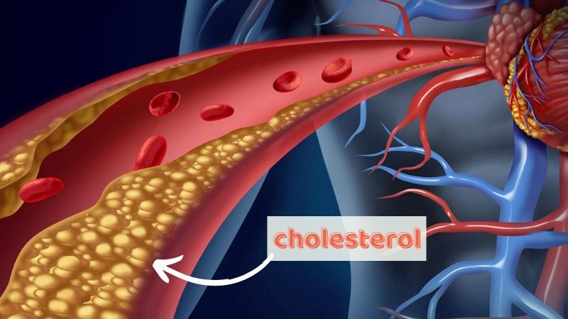 Giảm mức natri tiêu thụ làm tăng cholesterol LDL (xấu)