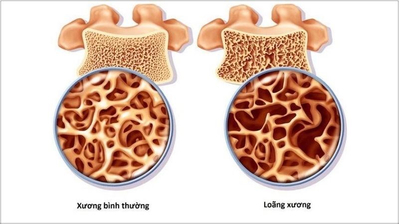 Quả nhàu chứa một lượng canxi giúp ngăn ngừa tình trạng loãng xương