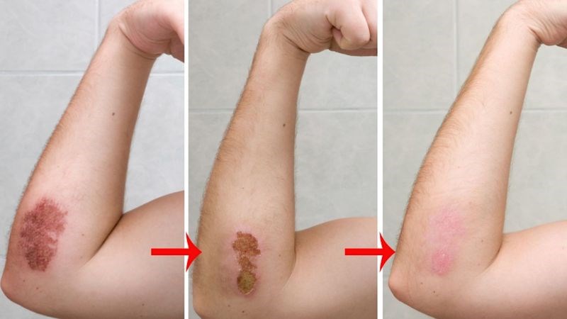 Curcumin giúp vết thương mau lành bằng cách giảm phản ứng viêm