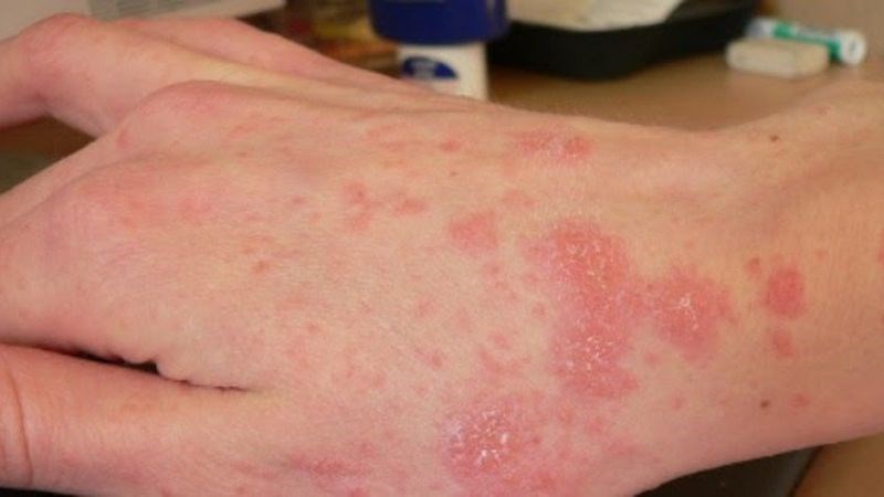 Nghệ có thể làm giảm triệu chứng sưng, tróc vảy, ngứa do viêm da cơ địa