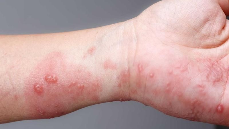 Nghệ kết hợp lá neem Ấn Độ hỗ trợ giảm các triệu chứng bệnh ghẻ
