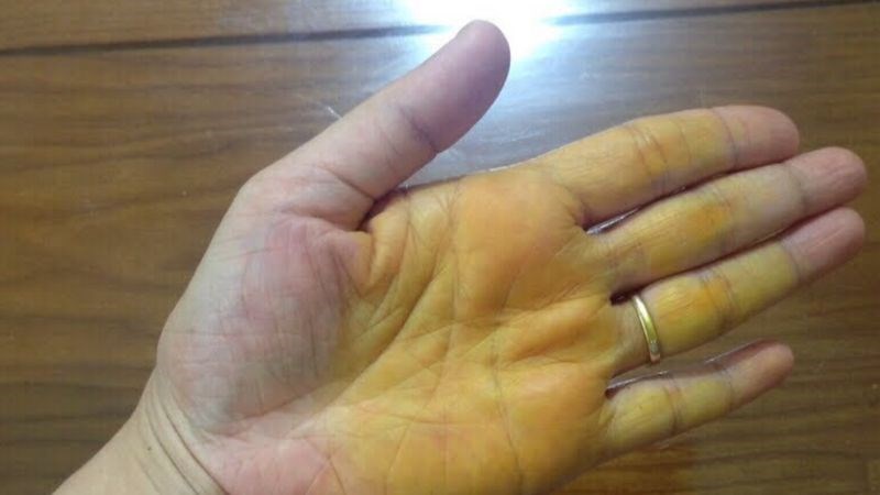 Thoa nghệ có thể gây ố vàng da