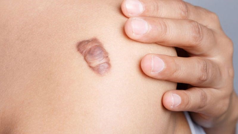 Sẹo là một phần của quá trình lành da sau khi bị tổn thương