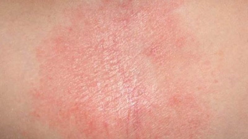 Một số người có thể bị phát ban trên da do dùng nghệ