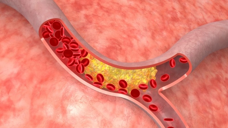 Chất xơ giúp giảm cholesterol LDL máu