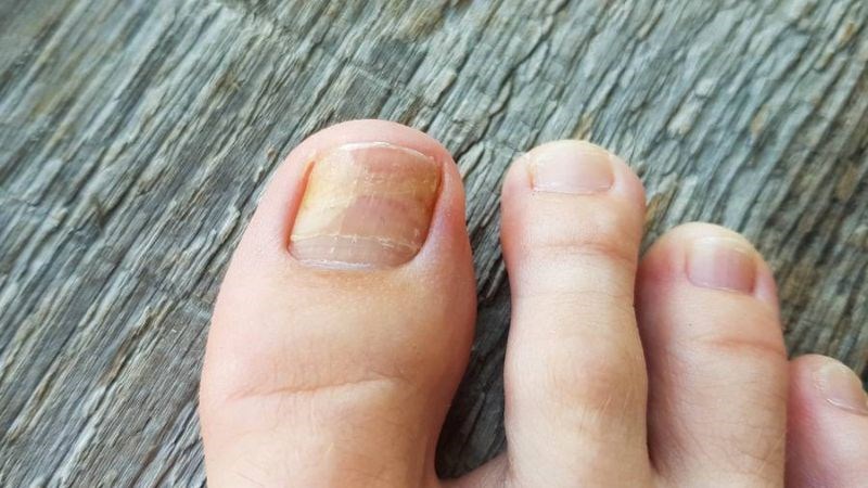 Long não có tác dụng điều trị nấm chân