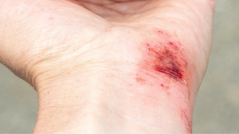 Mật ong Manuka thúc đẩy quá trình chữa lành vết thương ngoài da Mật ong Manuka thúc đẩy quá trình chữa lành vết thương ngoài da