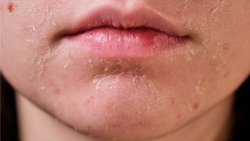 Mật ong Manuka tham gia phản ứng hydrat hóa giúp làm giảm tình trạng da khô, mụn Mật ong Manuka tham gia phản ứng hydrat hóa giúp làm giảm tình trạng da khô, mụn