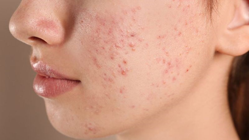 Mật ong Manuka có thể giúp phục hồi các nốt mụn bị viêm loét Mật ong Manuka có thể giúp phục hồi các nốt mụn bị viêm loét