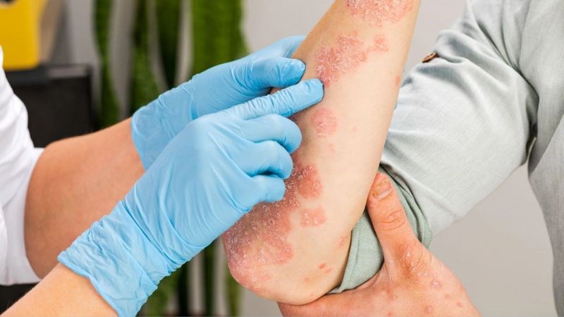 Ăn bông cải xanh có thể giúp làm dịu các triệu chứng viêm