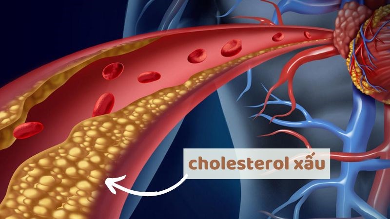 Ăn bông cải xanh giúp làm giảm lượng cholesterol xấu