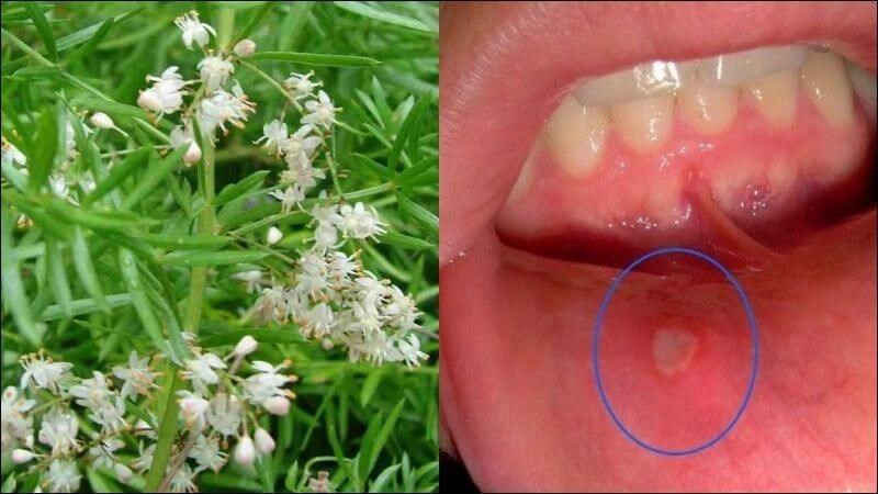 Bài thuốc kết hợp thiên môn, mạch môn, huyền sâm để trị loét miệng lâu ngày không khỏi