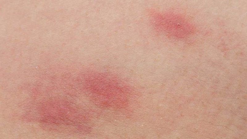 Chạm vào lá thường xuất có thể gây phát ban trên da
