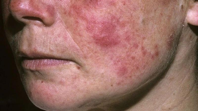 Lactobacillus reuteri hỗ trợ điều trị Lupus ban đỏ hệ thống