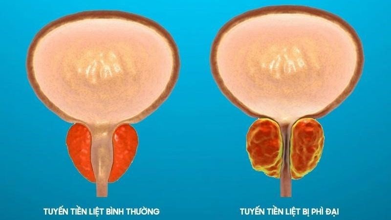 Cây Saw palmetto giúp giảm nguy cơ mắc phì đại tuyến tiền liệt