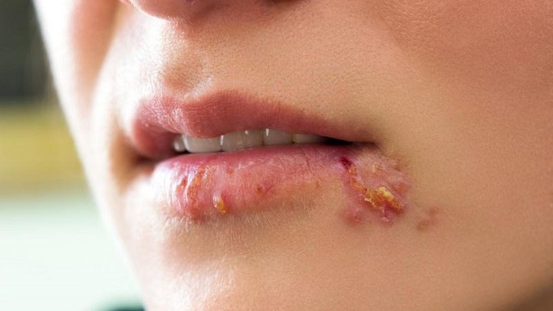 Đặc tính chống viêm của bạch đàn có thể làm giảm các triệu chứng của bệnh herpes