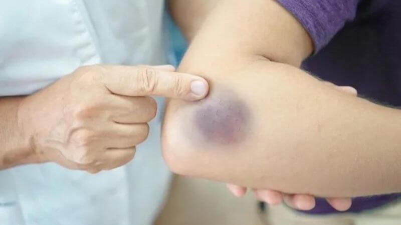 Proanthocyanidin trong dầu hạt nho giúp giảm tình trạng sưng tấy Proanthocyanidin trong dầu hạt nho giúp giảm tình trạng sưng tấy
